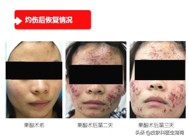 水楊酸棉片使用方法